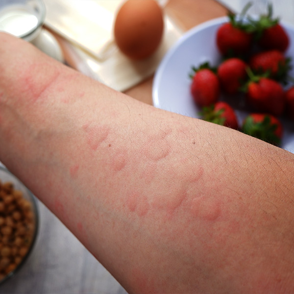 Understand Your Food Allergies Today