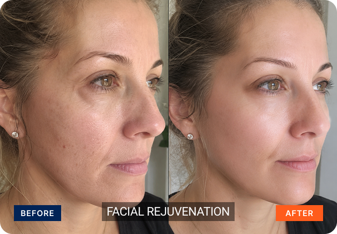 facial-rejuvination-2