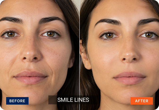 fillers-img-11