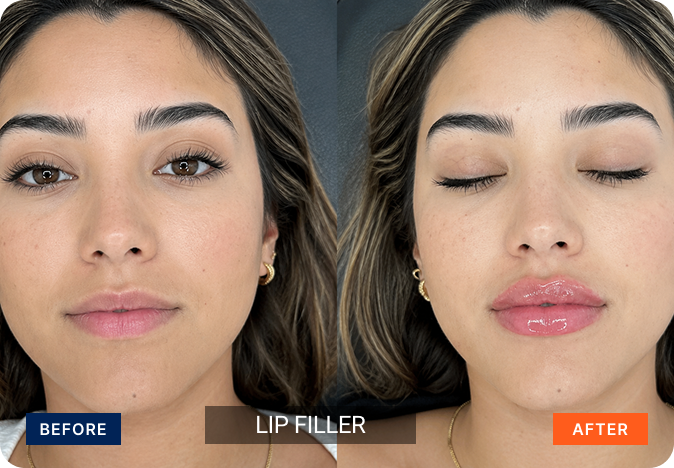 fillers-img-12