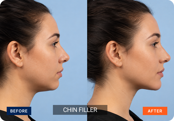 fillers-img-13