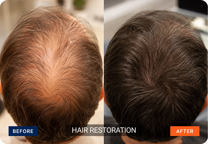 hair-restoration