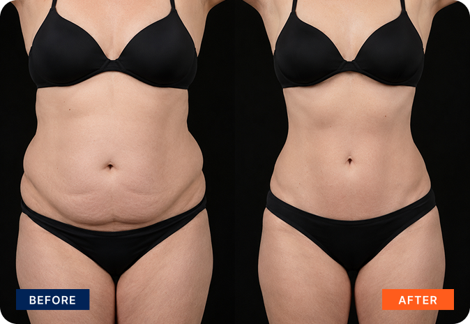 img-body-contour-3