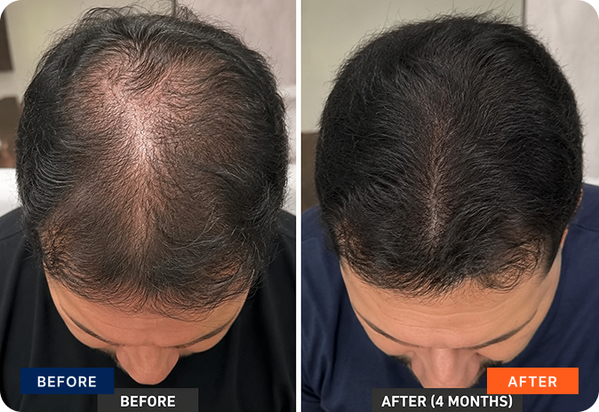 img-exosome-hair-3