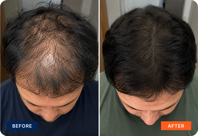 img-exosome-hair-4