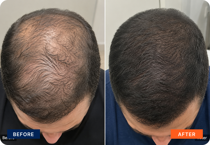 img-exosome-hair-7