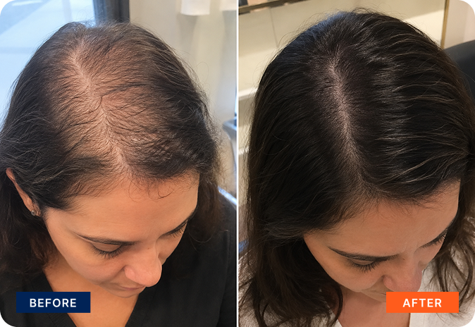 img-stem-cell-hair-6