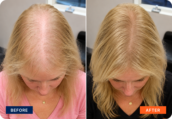 img-stem-cell-hair-7